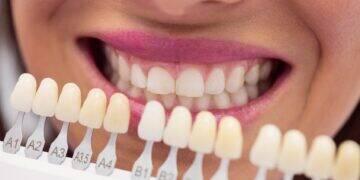 Pesquisa mostra que facetas alemãs resgatam autoestima 3 Pesquisa mostra que facetas alemãs resgatam autoestima