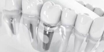 Implante zigomático traz nova alternativa na implantodontia 3 Implante zigomático traz nova alternativa na implantodontia