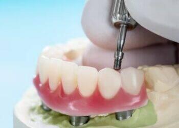 Implante zigomático garante tratamento ágil a pacientes