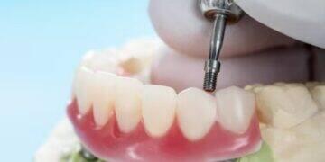 Implante zigomático garante tratamento ágil a pacientes 3 Implante zigomático garante tratamento ágil a pacientes