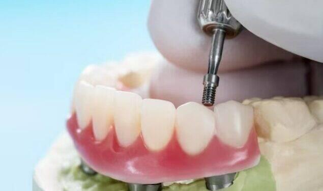 Implante zigomático garante tratamento ágil a pacientes 16 Implante zigomático garante tratamento ágil a pacientes