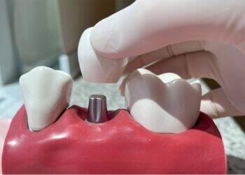 Cresce busca por implantes dentários com tecnologia digital
