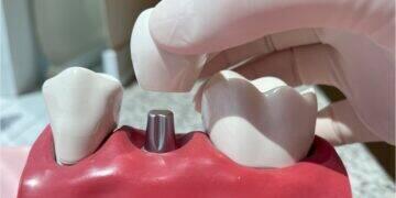 Cresce busca por implantes dentários com tecnologia digital 3 Cresce busca por implantes dentários com tecnologia digital