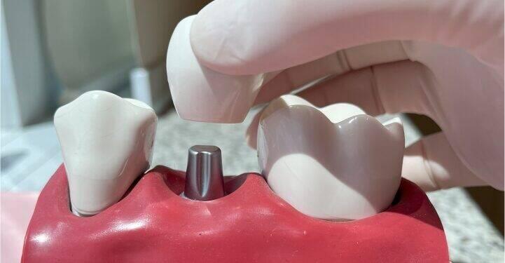 Cresce busca por implantes dentários com tecnologia digital 16 Cresce busca por implantes dentários com tecnologia digital