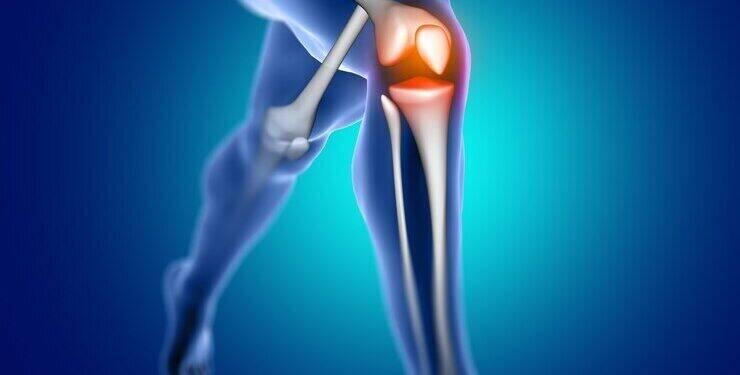 Artroplastia de joelho e quadril: para que serve a cirurgia 16 Artroplastia de joelho e quadril: para que serve a cirurgia