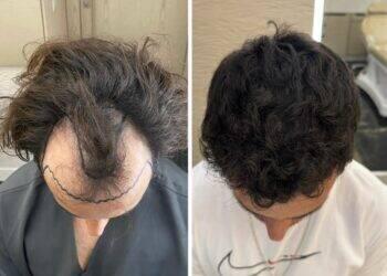 Inovações ajudam a popularizar busca por transplante capilar