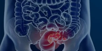 Mortes por câncer colorretal podem quase triplicar no Brasil até 2030